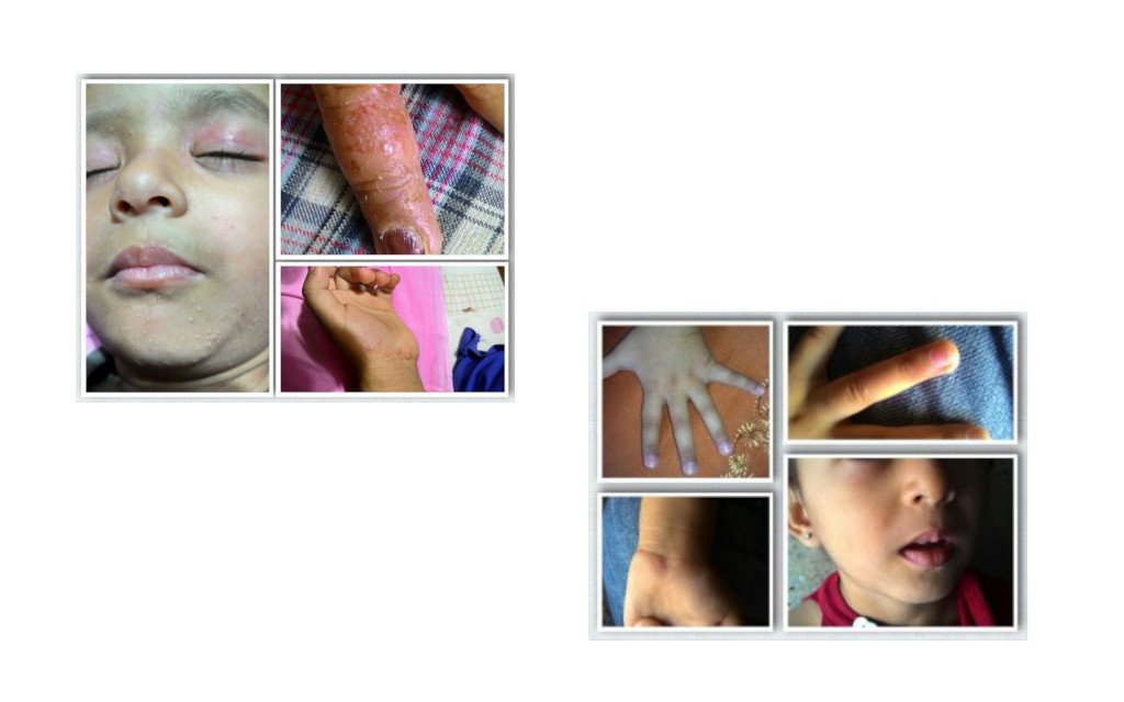 A Case of Molluscum Contagiosum