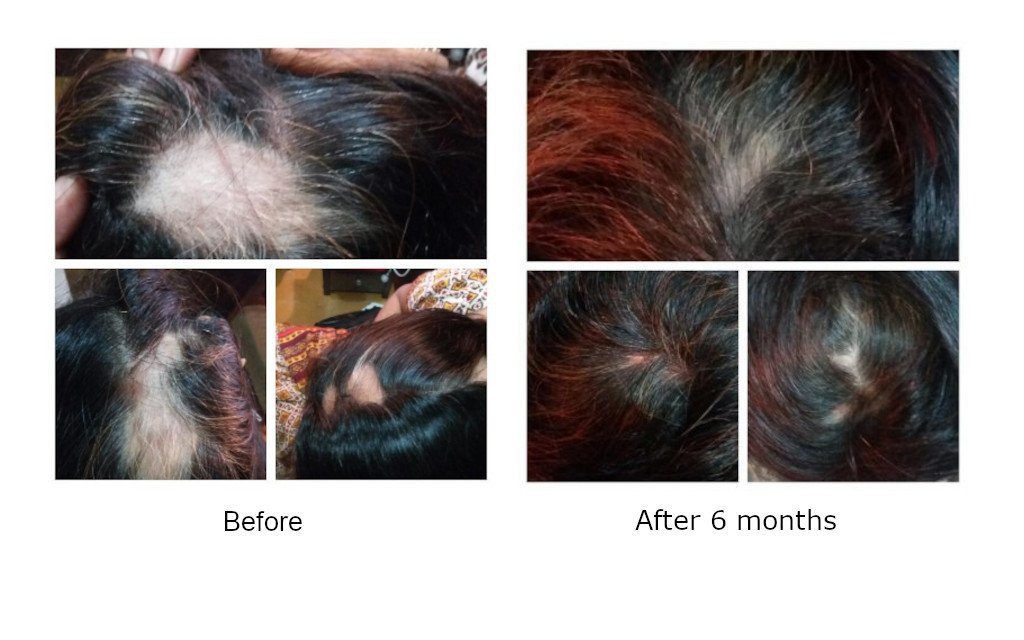 A Case of Alopecia Areata